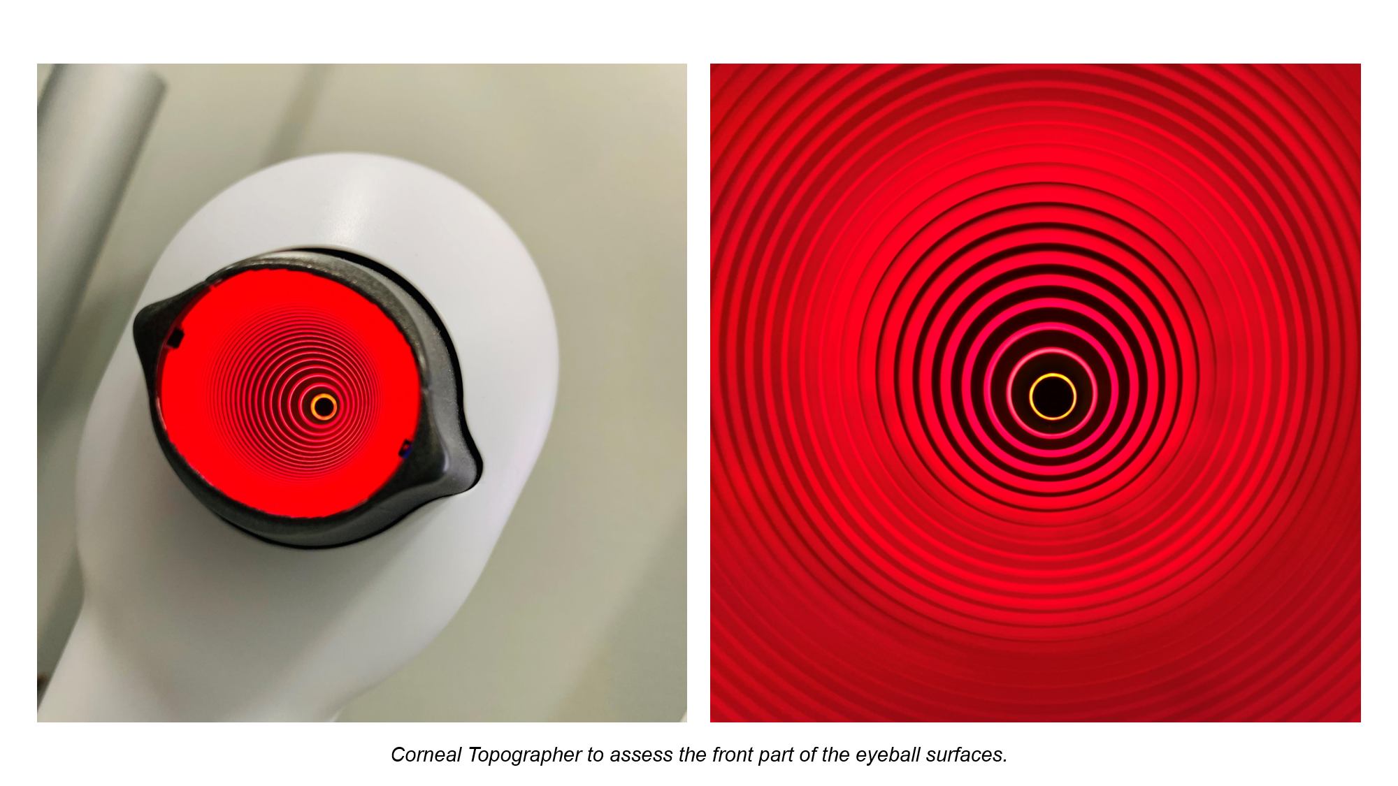 photo - keratoconus